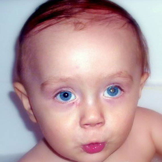 Niespe�na roczny Piotru� Wr�bel walczy o �ycie. Organizm dziecka zaatakowa� nowotw�r 