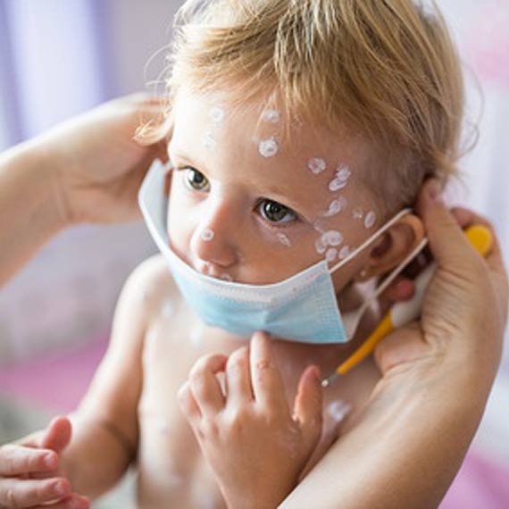 Ospa w jednym z kamieskich przedszkoli. Sanepid uspokaja: Ospa wietrzna jest najczstsz chorob zakan wieku dziecicego